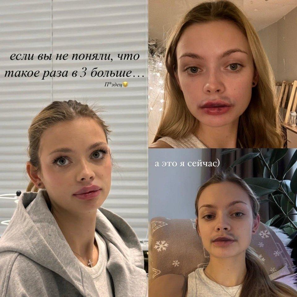 🔥Аня Ищук решила отказаться от инъекций и сдуть свои губы после четырех лет регулярных процедур.