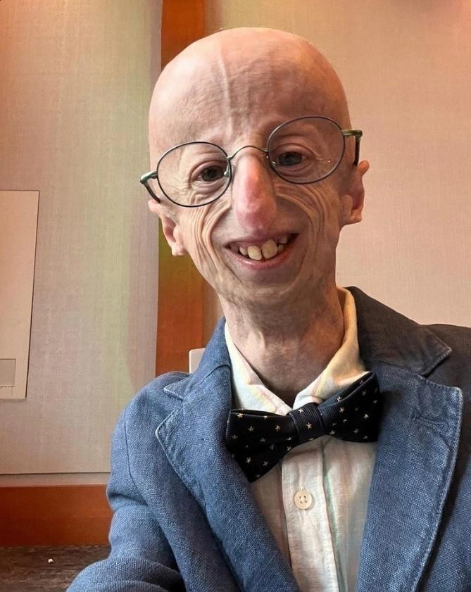 Умер Сэмми Бассо — человек с синдромом Гетчинсона-Гилфорда, проживший значительно дольше большинства пациентов с этим редким заболеванием.