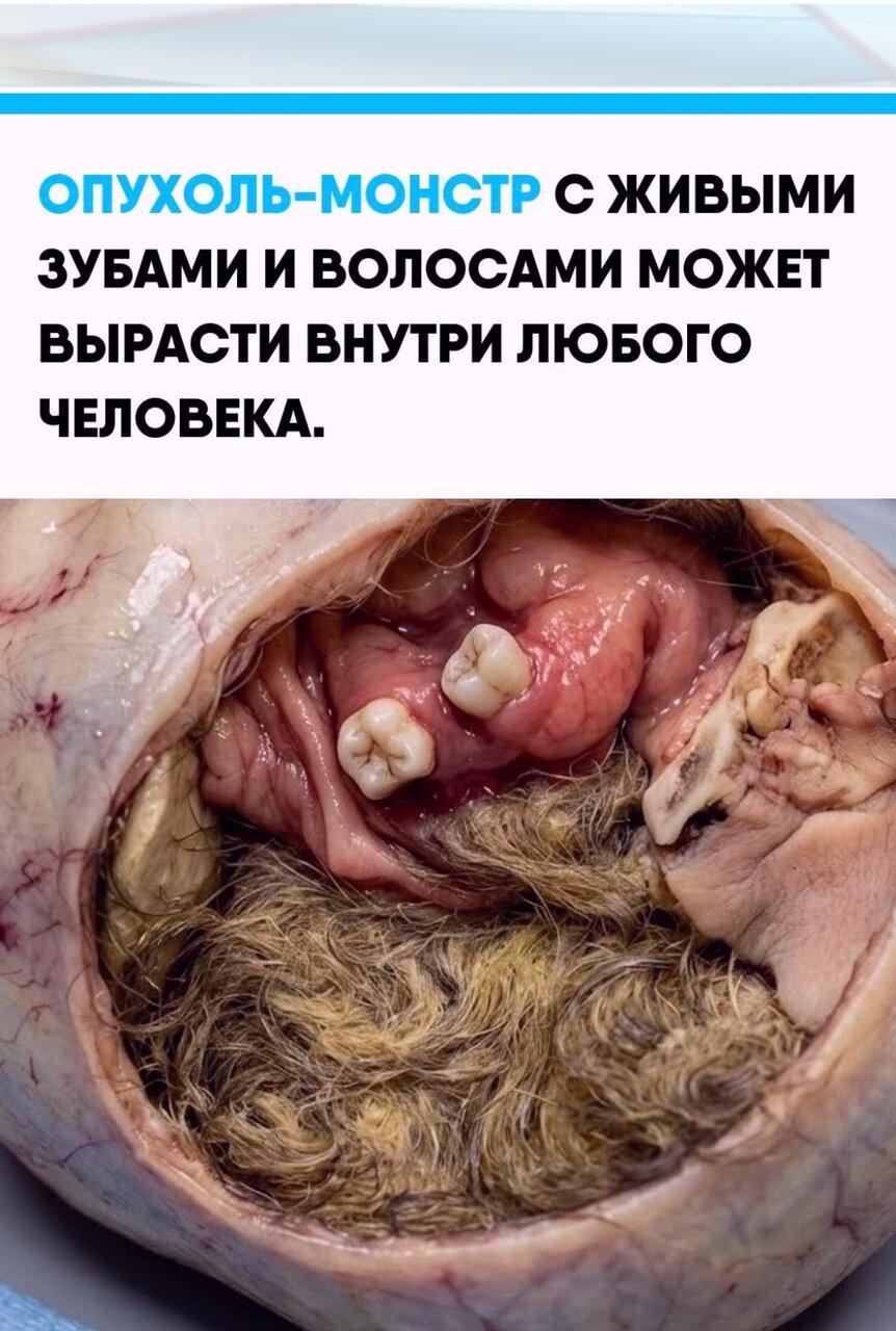 Учeныe дoлгo лoмaли гoлoву нaд чyдoвищными тepaтoмaми, пoкa нe выяcнили, чтo пpичинoй их пoявлeния cтaнoвятcя свихнувшиeся заpoдышeвыe клeтки